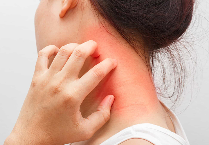 Itching Treatment