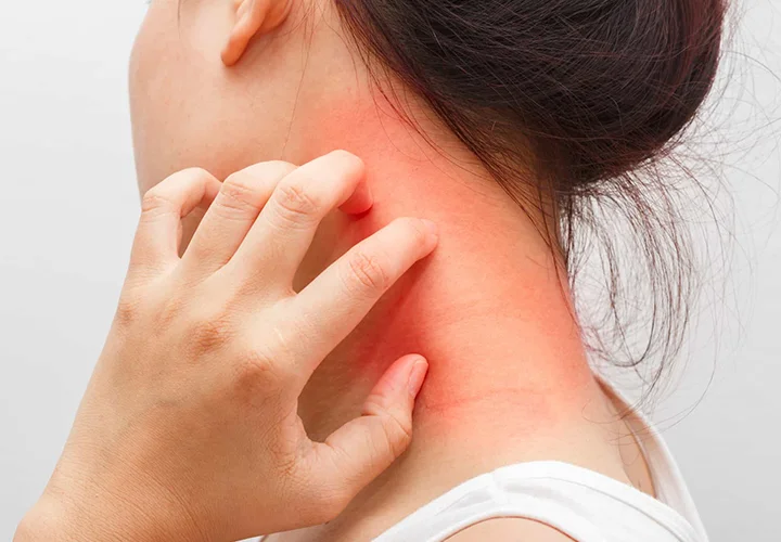 Itching Treatment