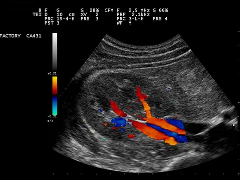 Color Doppler